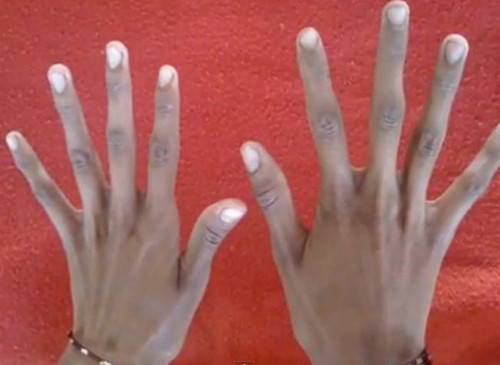 Hội chứng Marfan. Hội chứng Marfan là một rối loạn di truyền có ảnh hưởng đến các mô liên kết, hỗ trợ và kết nối cơ quan và các cấu trúc khác trong cơ thể. Người mắc hội chứng này có thể bị gián đoạn trong phát triển một số cơ quan, phổ biến nhất là tim, mắt, mạch máu và xương. Biểu hiện của bệnh gồm cao, mảnh mai, cánh tay dài, chân, ngón tay và ngón chân không tương xứng, cột sống cong.