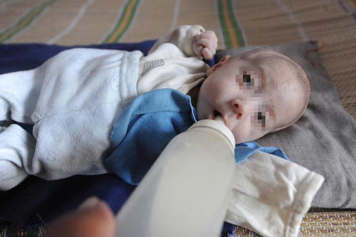  Em bé da bọc xương Gou Enze (Hồ Quan, Sơn Tây, Trung Quốc) được chẩn đoán mắc imperforate anus - chứng hậu môn không có lỗ nên không bài tiết được chất thải. Bệnh thật khiến cậu bé 3 tháng chỉ nặng 2kg, tay chân teo tóp nhưng bụng căng phồng, da xanh bủng.