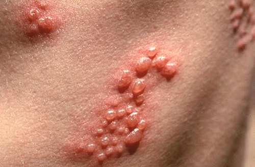 U, mụn lạ. Mụn lạ thường mọc nhiều ở vùng mu. Nó dễ dàng được phát hiện khi bạn làm sạch, cắt tỉa lông vùng kín. Có nhiều nguyên nhân gây mụn ở âm đạo nhưng hầu hết chúng không quá nghiêm trọng. Nó có thể là một khối u nang bã nhờn do lông mọc ngược vào da.