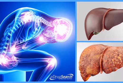 Đổ mồ hôi trộm vào ban đêm Thời tiết mát mẻ hoặc ngủ trong phòng điều hòa, một số người vẫn có triệu chứng đổ mồ hôi, đặc biệt ở lòng bàn tay và lòng bàn chân. Điều này theo y học phương Đông cho thấy bạn bị chứng can âm hư, dẫn đến mồ hôi không được kiềm chế. Lúc này cần uống thuốc để điều hòa gan. Theo Đông y, bạn nên ăn nhiều củ từ (khoai từ), thịt gà hầm để giúp tẩm bổ cho gan.
