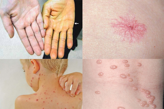 Khô và đắng miệng Thông thường trong quá trình ngủ, nếu bạn luôn cảm thấy khô và đắng miệng, bạn cần cảnh giác với bệnh ung thư gan. Bình thường, trong quá trình phát triển bệnh ung thư gan, khả năng vận chuyển của gan bị giảm và độc tố trong cơ thể không thể được đào thải kịp thời hoặc có trường hợp xuất hiện tình trạng trào ngược dịch mật.