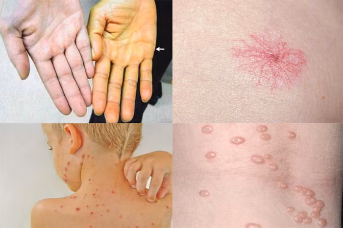 Khô và đắng miệng Thông thường trong quá trình ngủ, nếu bạn luôn cảm thấy khô và đắng miệng, bạn cần cảnh giác với bệnh ung thư gan. Bình thường, trong quá trình phát triển bệnh ung thư gan, khả năng vận chuyển của gan bị giảm và độc tố trong cơ thể không thể được đào thải kịp thời hoặc có trường hợp xuất hiện tình trạng trào ngược dịch mật.