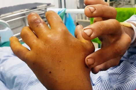 Theo bệnh nhân, chiều 4 ngày trước, người này đang phát cỏ tại khu vườn nhà mình thì bị rắn lục cắn vào ngón tay ở bàn tay trái. Khi vết thương sưng tấy, người thân đưa nạn nhân đến gặp thầy lang gần nhà để bó thuốc. Vị thầy lang dùng kim đâm vào vết thương, nặn máu ra ngoài rồi đắp thuốc “lạ” điều trị. Một ngày sau, người đàn ông 34 tuổi rơi vào trạng thái mệt mỏi, vết thương sưng to và rỉ máu… phải nhập viện cấp cứu.