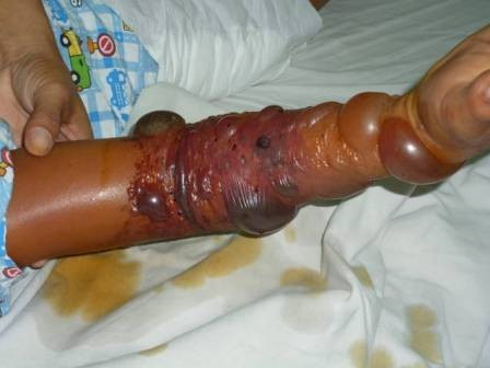 Trước đó, một bệnh nhân khác nhập viện trong tình trạng hoại tử vết thương khiến tay co quắp lại. Sau khi tiến hành cấp cứu qua cơn nguy kịch, các bác sĩ khuyên bệnh nhân đến viện Bỏng để phẫu thuật ghép da nhưng người này đã về nhà đắp thuốc. Hành động này khiến cánh tay bị rắn cắn co quắp giống cành cây khô.