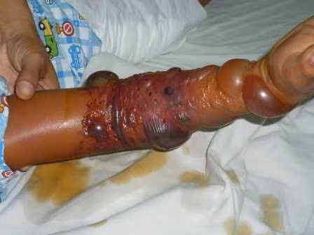 Trước đó, một bệnh nhân khác nhập viện trong tình trạng hoại tử vết thương khiến tay co quắp lại. Sau khi tiến hành cấp cứu qua cơn nguy kịch, các bác sĩ khuyên bệnh nhân đến viện Bỏng để phẫu thuật ghép da nhưng người này đã về nhà đắp thuốc. Hành động này khiến cánh tay bị rắn cắn co quắp giống cành cây khô.