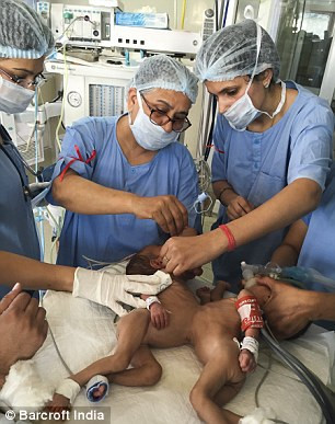 Tiến sĩ Ravi Kanojia, giáo sư tại khoa phẫu thuật nhi khoa, người đứng đầu nhóm nghiên cứu về các trường hợp song sinh, cho biết cơ hội sống sót hai bé thuộc vào dạng nghìn cân treo sợi tóc. "Đây là một tình huống hiếm gặp. Tôi rất may mắn thấy được vài trường hợp thế này trong cuộc đời mình”, ông này nhấn mạnh.