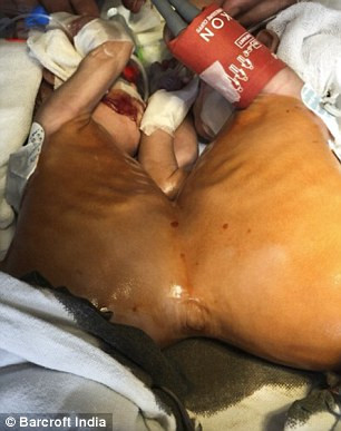 Các bác sĩ đã tiến hành một loạt xét nghiệm bao gồm cả chụp CT và MRI để tìm ra các bộ phận chung của hai cơ thể bệnh nhi. Họ thấy hai bé song sinh này có chung một lá gan, song rất may các cơ quan nội tạng còn lại đều riêng biệt. Tại thời điểm phẫu thuật, hai bệnh nhi mới được 3 tháng tuổi, nặng tổng cộng 4,2 kg. Các bác sĩ lo ngại phẫu thuật chậm trễ có thể cản trở sự phát triển của các bé.