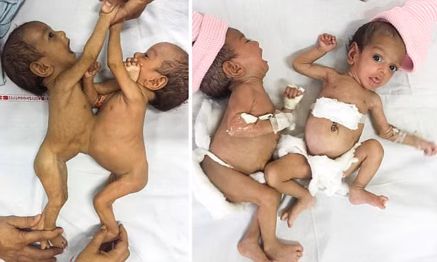 Sau khi phẫu thuật, bé Jannat rất khỏe mạnh, còn Mannat nhỏ và yếu hơn nên phải dùng máy thở một thời gian. Mannat cần thêm một tiểu phẫu để loại bỏ các lưới bụng trong 3-4 tháng tới. Sức khỏe các bé đang dần được hồi phục.