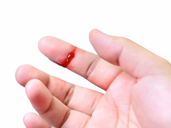 Xử lý vết thương hở an toàn. Nếu không may bị vết thương hở và tiếp xúc trực tiếp với máu của người nhiễm bệnh, thì bạn cũng có thể bị nhiễm AIDs. Do vậy, khi bạn đang phải tiếp xúc với người bệnh hay khu vực có bệnh nhân AIDs, hãy che chắn vết thương hở hoặc tránh xa khu vực này.