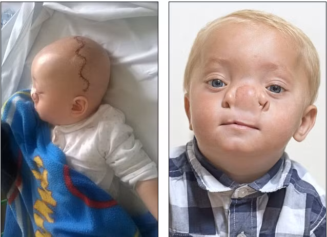 Tháng 11/2014, Ollie Trezise đã trải qua cuộc phẫu thuật kéo dài 2 giờ tại Viện nhi Birmingham nhằm loại bỏ các túi dịch não thừa và chỉnh hình mũi. Nhưng trong tương lai, cậu bé vẫn còn phải trải qua những ca phẫu thuật khác nữa.