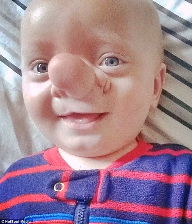 Được biết, khi mẹ cậu bé mang thai 20 tuần tuổi, siêu âm đã phát hiện điểm bất thường. Dù đã chuẩn bị tinh thần nhưng người mẹ 22 tuổi Amy Poole vẫn rất sốc khi lần đầu nhìn thấy con tại Bệnh viện Đại học Cardiff vào tháng 2/2014.