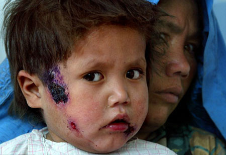 Ký sinh trùng sẽ tiếp tục phát triển, sinh sản, liên tục tấn công vào tế bào lành bên cạnh. Các triệu chứng khác của bệnh bao gồm như tiêu chảy, sốt cao, suy nhược... tuy nhiên nhiều trường hợp bệnh nhân không biểu lộ triệu chứng nào. May mắn không gặp biến chứng, vết loét sẽ thành sẹo lõm sau 2-12 tháng. Còn nếu không được chữa trị kịp thời, tỷ lệ bệnh nhân tử vong là 100% trong vòng 3-20 tháng.