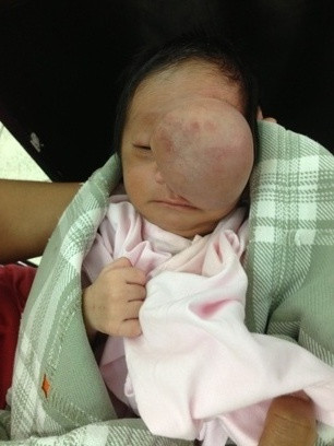 Bệnh thoát vị màng não tủy là một bệnh thường gây biến dạng nặng khuôn mặt, gây viêm nhiễm hô hấp kéo dài, cản trở việc ăn uống. Bệnh nếu không điều trị sẽ phát triển to lên rất nhanh theo thời gian do mô não, dịch não tủy tiếp tục thoát vị xuống dưới, gây khiếm khuyết thần kinh và mất thẩm mỹ nghiêm trọng.