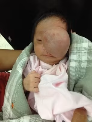 Bệnh thoát vị màng não tủy là một bệnh thường gây biến dạng nặng khuôn mặt, gây viêm nhiễm hô hấp kéo dài, cản trở việc ăn uống. Bệnh nếu không điều trị sẽ phát triển to lên rất nhanh theo thời gian do mô não, dịch não tủy tiếp tục thoát vị xuống dưới, gây khiếm khuyết thần kinh và mất thẩm mỹ nghiêm trọng.