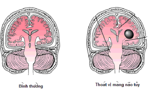 Cũng giống như các bệnh lý về não khác, thoát vị màng não tủy rất nguy hiểm và dễ gây ra các biến chứng về hô hấp. Bệnh xảy ra do khuyết cung sau rộng làm cho ống sống thông với phần mềm ngoài ống sống. Điều này dẫn đến việc màng cứng tuỷ dễ dàng phình ra và tạo thành túi thoát vị.
