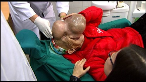 PGS.TS Trịnh Đình Hải, Viện trưởng Viện Răng Hàm Mặt trung ương cho biết thêm, trước nay chưa từng có bệnh nhân nào thoát vị màng não kéo dài gây khối u lớn như bệnh nhân Triệu Mùi Chài mới chịu đến viện. Với tình trạng khối u lớn, phẫu thuật sẽ khó khăn hơn.