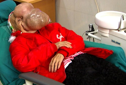 Như trường hợp của bà Chài là một điển hình, hằng ngày, bà Chài sống trong đau đớn do căn bệnh quái ác hành hạ. Theo bà Chài cho biết, khối u bắt nguồn từ một mụn cơm nhỏ cách đây đã gần 20 năm, sau đó mụn này cứ lớn dần, che kín mặt.