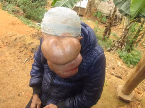 Các bác sĩ của Bệnh viện Răng Hàm Mặt Trung ương và Bệnh viện Hữu nghị Việt Đức khẳng định, căn bệnh mà bà Triệu Mùi Chài ở Cao Bằng, người mang khối u khổng lồ trên mặt nặng tới hơn 3kg suốt 25 năm qua mắc phải là thoát vị màng não tủy.