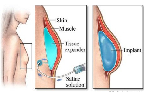 Nâng ngực nội soi. Dĩ nhiên, không thể không kể đến việc nâng ngực hay bơm mông trong xu hướng thẩm mỹ. Có thể nói loại phẫu thuật này năm nào cũng có, năm nào cũng chuộng, được đón nhận sớm và ngày càng được chấp nhận rộng rãi.