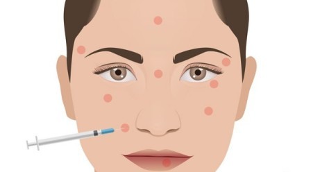 Không sử dụng những chất liệu độn, bơm mỡ tự thân là phương pháp lấy mỡ từ những vùng thừa mỡ của cơ thể như bụng, mông, đùi để bơm vào những vùng đang thiếu hụt độ căng đầy như hõm má, cằm, thái dương, trán giúp khuôn mặt trở nên đẹp đầy đặn, xóa đi vẻ già nua khắc khổ.