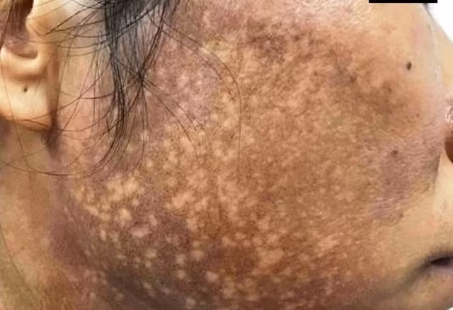 Boi kem tron lam trang da, nguoi phu nu nhan cai ket khung khiep