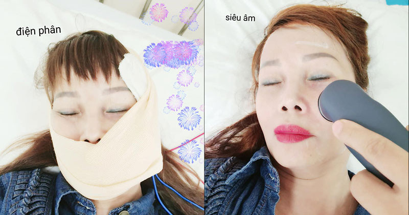 Hình ảnh chị Thu Sao đang trong quá trình chạy vật lý trị liệu để điều trị "méo miệng" được chia sẻ lên mạng xã hội.