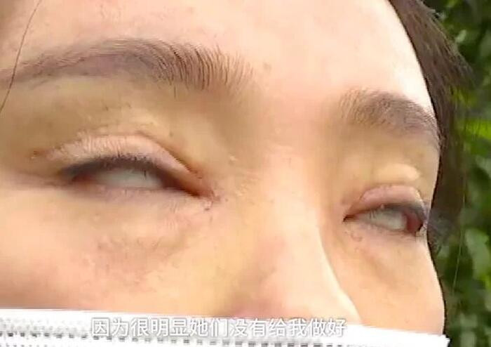 Tình trạng của cô gái này trở nên trầm trọng hơn khi cô không thể nhắm mắt. Mỗi khi thấy mỏi mắt, cô chỉ có thể ngước mắt lên trời để nghỉ ngơi.