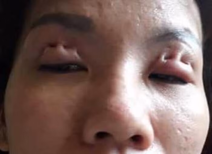 Chỉ vì ham rẻ nên cô gái này đã gánh chịu hậu quả làm tổn hại đến nhan sắc của mình.