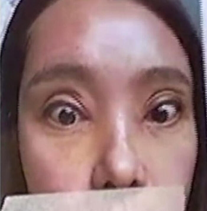 Cô gái này đã chi ra 12.800 NDT (khoảng 40 triệu đồng) cho ca phẫu thuật này. Tuy nhiên, kết quả không như mong đợi.