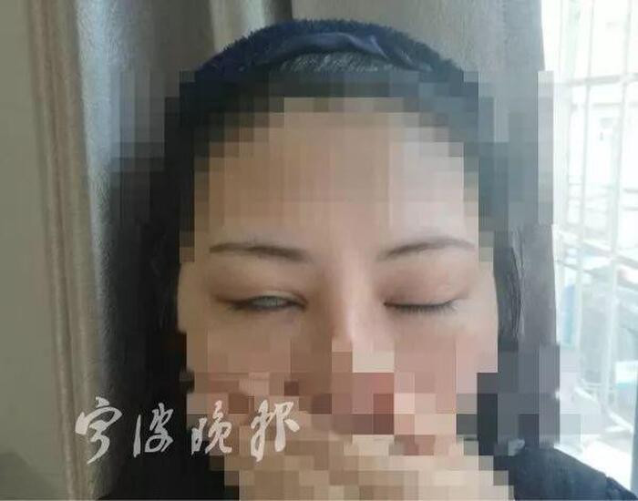 Một nạn nhân khác của việc phẫu thuật cắt mí hỏng.