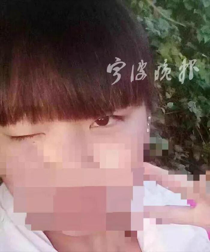 Một trường hợp phẫu thuật hỏng khác khiến cô gái này một mắt nhắm, một mắt mở.