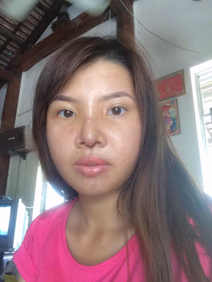 Gương mặt mộc đầy mụn, sưng tấy, làn da đen sạm của Phượng đối lập hoàn toàn với những bức ảnh trước đó.