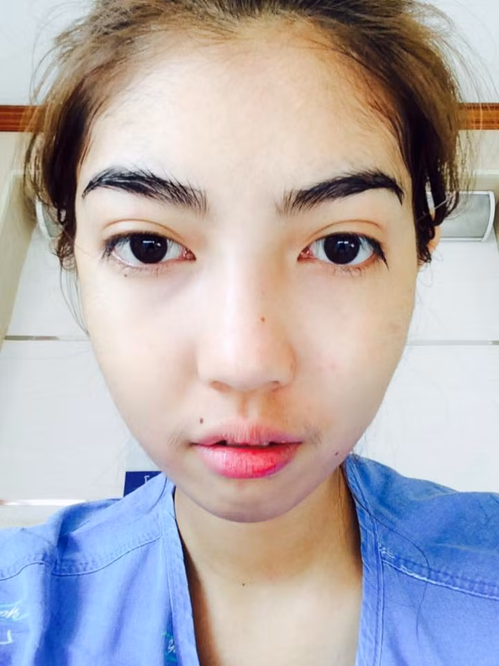 Khuôn mặt biến dạng của nữ sinh 17 tuổi trở về như bình thường, thậm chí đôi mắt còn to tròn và đẹp hơn trước.