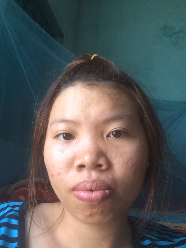 Sau 14 ngày trải qua quá trình "dao kéo", Kim Phượng cho biết: "Các cuộc phẫu thuật gần như đã hoàn tất. Mình cảm thấy sức khỏe vẫn rất ổn, so với những cảnh báo trước đây thì mình thấy phẫu thuật cũng không đau đớn như tưởng tượng".