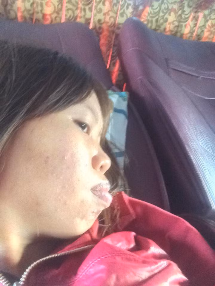 Và với số tiền được bố mẹ gom góp đưa cho, Kim Phượng quyết định "đập đi xây lại" khuôn mặt, trong đó cắt hàm hô có giá 65 triệu đồng; hạ gò má là 45 triệu đồng; nâng mũi cấu trúc 31 triệu đồng; nhấn mí 3,5 triệu đồng; làm chân mày và môi thêm tổng cộng là 4 triệu đồng.