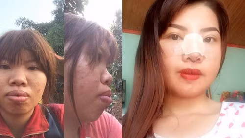 Hình ảnh Quách Thị Kim Phượng trước và sau khi phẫu thuật thẩm mỹ từng nhận được nhiều sự quan tâm của người xem.