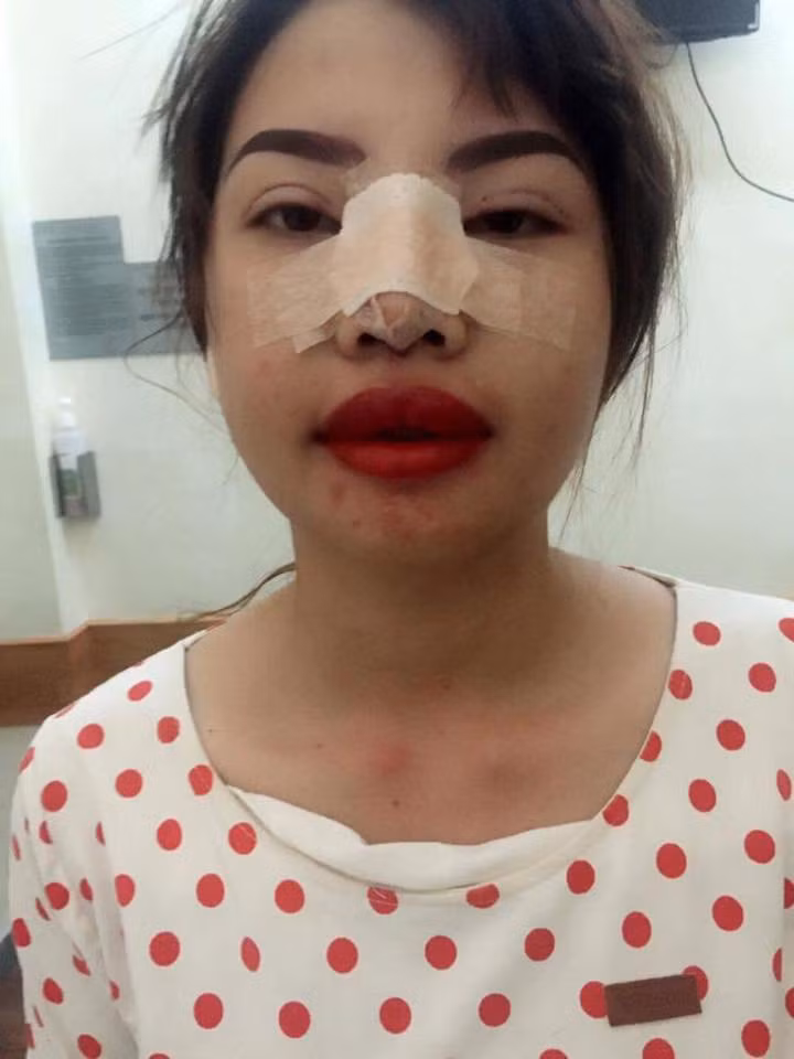 Sau nghỉ dưỡng được 13 ngày, Phượng muốn khắc phục nốt chiếc mũi tẹt dí, đầu mũi to và hếch hẳn lên, nên quyết định tiếp tục phẫu thuật nâng mũi cấu trúc và nhấn mí.