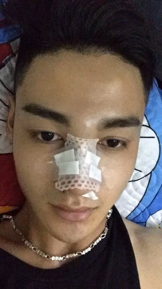 Bác sĩ lấy sụn tai và làm mũi Sline cho mình, về uống 1 viên giảm đau là hết đau luôn. Nhưng do ham chơi quá, ngay hôm sau đi Phú Quốc luôn nên bị tụ máu vào mắt mất 1 tháng mới hết… nhưng cuối cùng mình cũng được hài lòng.