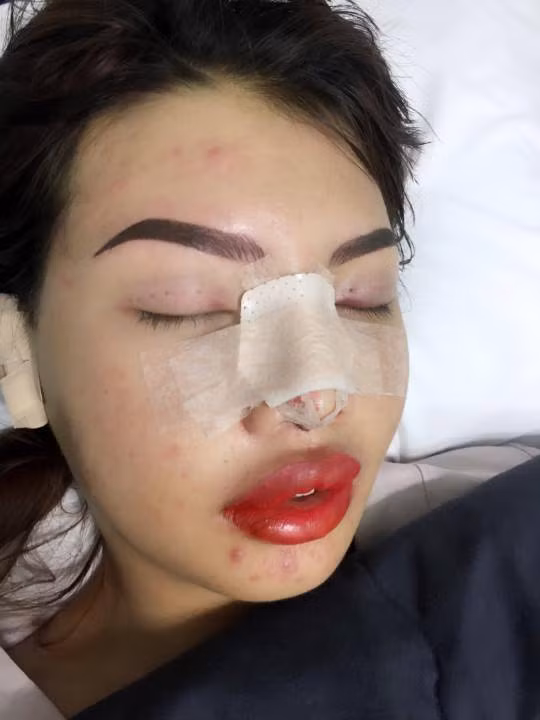 Quách Phượng sau khi vừa trải qua quá trình phẫu thuật.