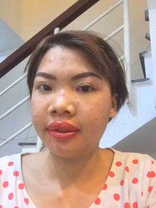 Bà mẹ đơn thân đến từ Đắk Nông nhận được nhiều sự quan tâm và theo dõi của hàng nghìn người trên trang Facebook cá nhân nhờ việc không ngại ngần công khai quá trình lột xác ngoạn mục của mình. Mới đây, bác sĩ phẫu thuật cho Quách Phượng còn chia sẻ thêm những hình ảnh liên quan đến hành trình "lên đời nhan sắc" của bà mẹ trẻ.