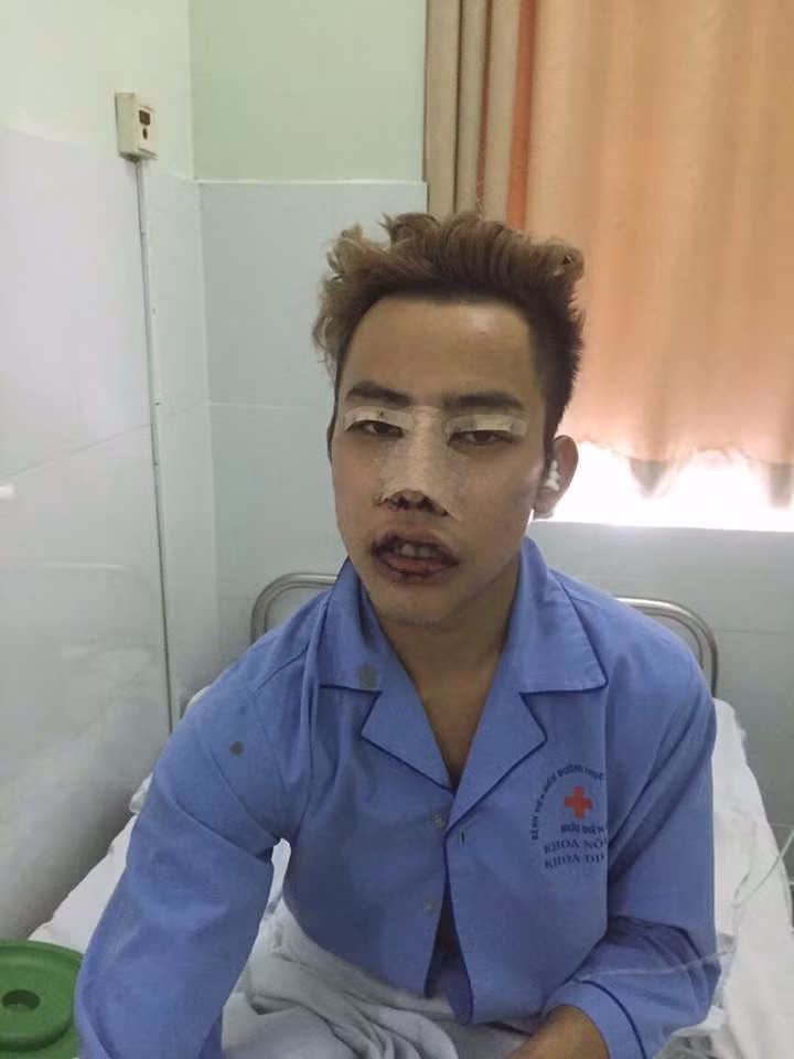 "Phẫu thuật đợt 2 đã xong nha mọi người: mũi + mắt + miệng. Cả nhà hãy đón xem màn lột xác toàn diện của Tùng Sơn thành hot girl nhé!", chàng trai 9X từng chia sẻ trên trang Facebook.