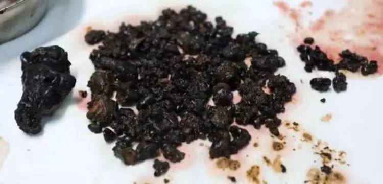 Phải mất tới 6 tiếng đồng hồ, các bác sĩ mới có thể lấy hết số lượng sỏi này ra khỏi cơ thể cô Chen. (Nguồn Oddee)