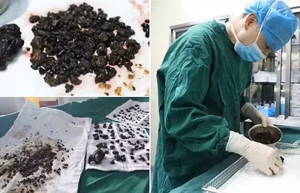 200 là số lượng viên sỏi các bác sĩ phẫu thuật tại bệnh viện Guanji, tỉnh Chiết Giang (Trung Quốc) đã lấy ra từ túi mật và gan của một người phụ nữ 45 tuổi tên là Chen, trong đó có những viên có kích thước to bằng quả trứng. (Nguồn Oddee)