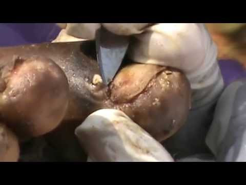 Khi bọ mẹ chết, vật chủ sẽ bị nhiễm trùng ở chân. Nếu không điều trị kịp thời, nạn nhân có thể bị hoại tử dẫn đến phải cắt bỏ phần cơ thể bị nhiễm trùng, trường hợp xấu nhất là dẫn đến tử vong.