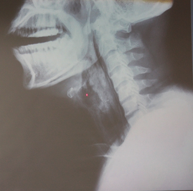 Cổ họng anh D. bị phù nề và tổn thương nặng vì bệnh viêm thanh thiệt cấp.