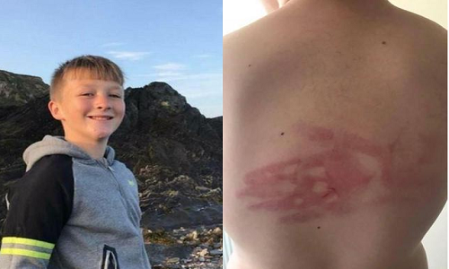 Cậu bé Ryan về nhà với dấu tay hằn rõ trên lưng vô cùng đau đớn.