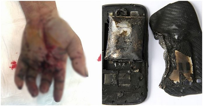 Trước đó, hồi tháng 5/2017, ông Triệu Văn T, ở Hòa Bình đã bị thương nặng bàn tay trái do nổ pin sạc điện thoại dự phòng. Ảnh: Trieucontim.
