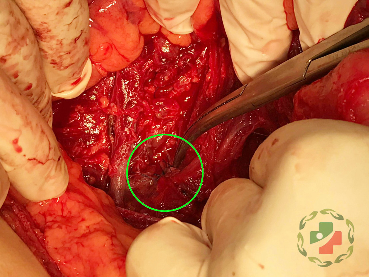 Bác sỹ CKI Vương Ngọc Chắt thăm khám cho bệnh nhân sau mổ