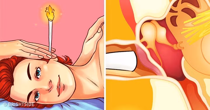 Lấy ráy tai bằng lửa: Điều này khá phổ biến ở một số nước như Trung Quốc, Ai Cập… với tên gọi ear-candling. Theo một nghiên cứu đăng trên tạp chí y học Laryngoscope (Mỹ), ear-candling không thể hút hết ráy tai ra bằng áp lực của lửa. Một khảo sát từng thực hiện với dịch vụ này cho thấy, 10% bệnh nhân từng dùng ear-candling đã bị phỏng nhẹ bên ngoài tai, bị sáp đèn cầy chảy vào trong tai và có trường hợp bị sây sát màng nhĩ.