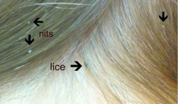 Chữa chấy: Trên các trang mạng xuất hiện phương pháp xử lý chấy trên đầu bằng việc bôi các loại dầu hỏa, xăng, thuốc trừ sâu... lên tóc. Tuy nhiên, tất cả các chất này đều độc tính cao và không bao giờ được sử dụng trên da. Một số khác sử dụng những chất khác như dầu ô liu, nước - an toàn tuyệt đối... nhưng hoàn toàn vô dụng. Biện pháp tốt nhất là nhận toa thuốc từ bác sĩ.